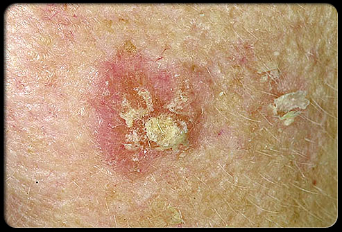 Skin Cancer Warning Signs - Associated Dermatology & Skin Cancer