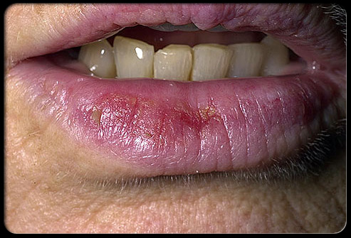 Skin Cancer Lower Lip Photos - Infoupdate.org