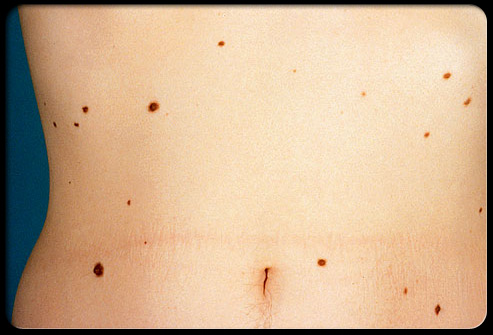 Skin Cancer Warning Signs – Associated Dermatology & Skin Cancer Clinic