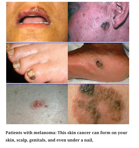 melanoma