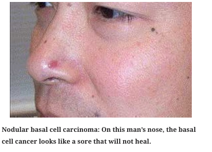 Melanoma Nose