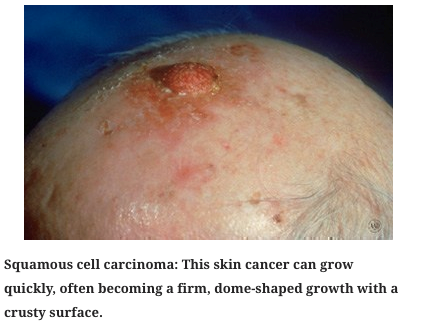 skin cancer 2