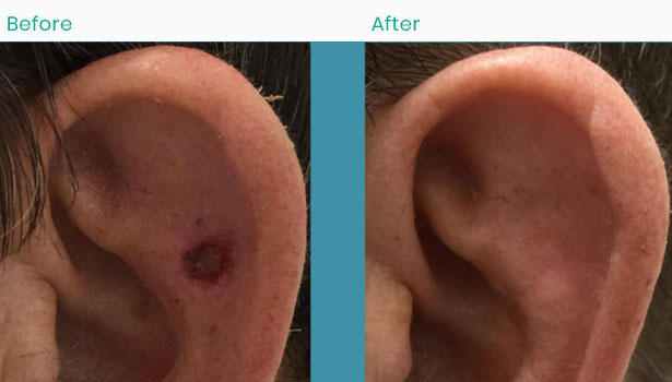 ear skin cancer