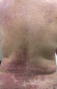 rash before medication